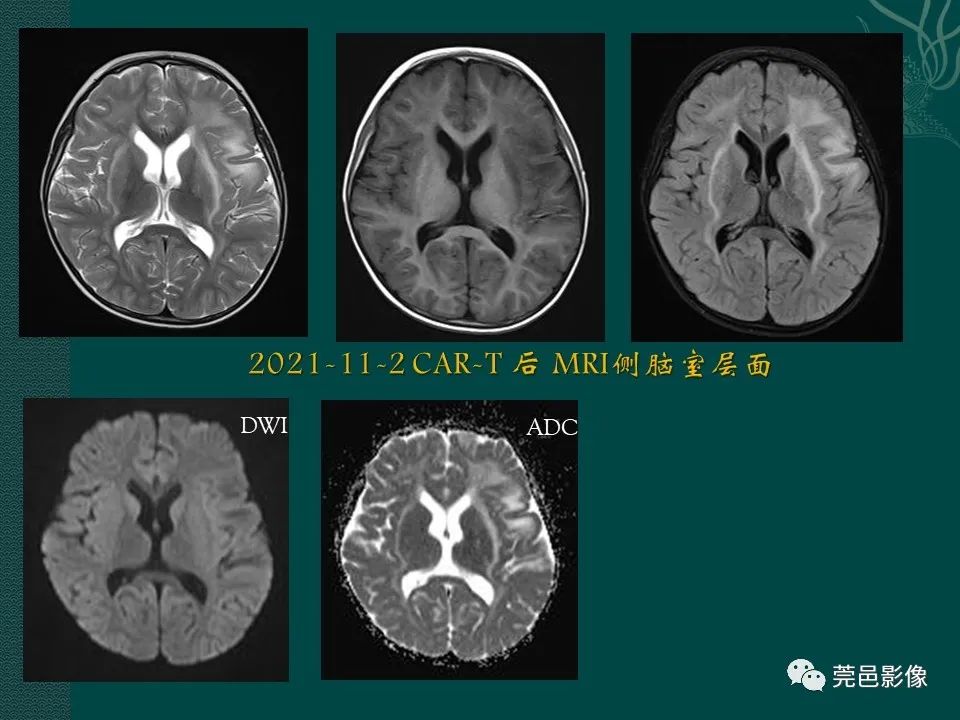 影像PPT - 【PPT】CAR-T治疗难治复发急性B淋巴细胞白血病相关性脑病（CRES）的影像学表现初步分析（1例）-11