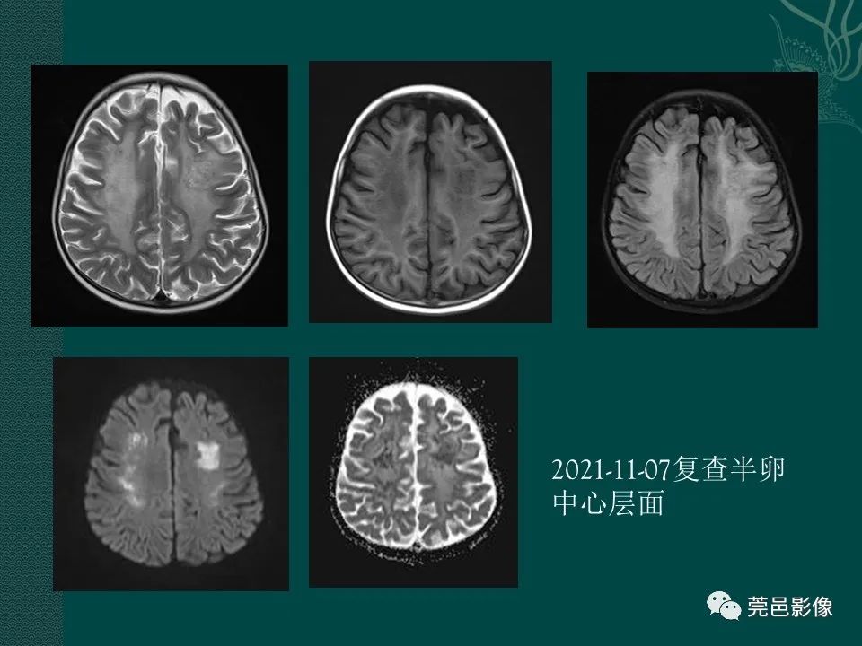 影像PPT - 【PPT】CAR-T治疗难治复发急性B淋巴细胞白血病相关性脑病（CRES）的影像学表现初步分析（1例）-14