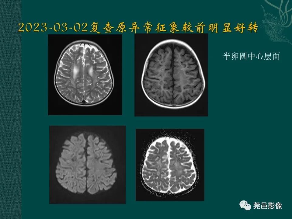 影像PPT - 【PPT】CAR-T治疗难治复发急性B淋巴细胞白血病相关性脑病（CRES）的影像学表现初步分析（1例）-22
