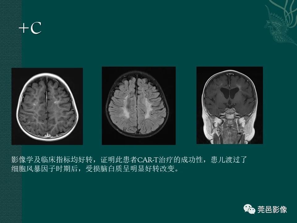 影像PPT - 【PPT】CAR-T治疗难治复发急性B淋巴细胞白血病相关性脑病（CRES）的影像学表现初步分析（1例）-24