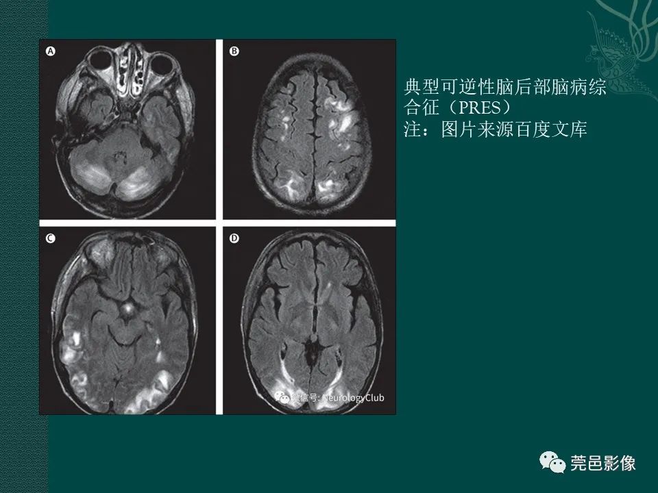 影像PPT - 【PPT】CAR-T治疗难治复发急性B淋巴细胞白血病相关性脑病（CRES）的影像学表现初步分析（1例）-31