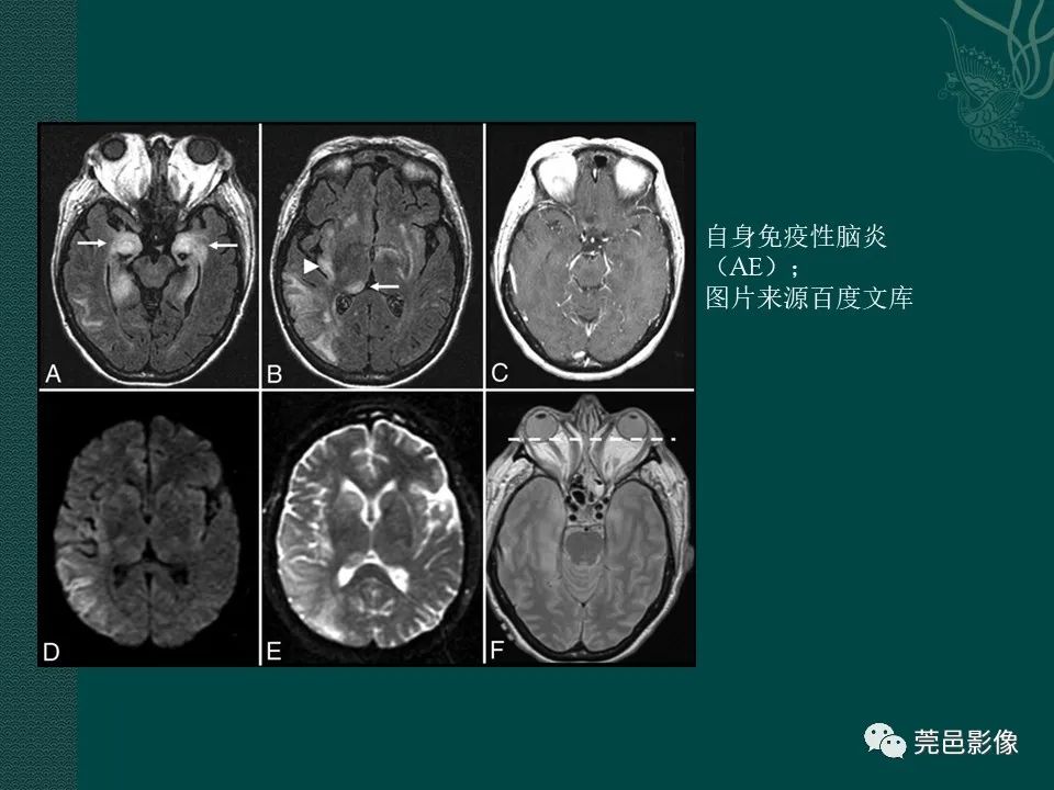 影像PPT - 【PPT】CAR-T治疗难治复发急性B淋巴细胞白血病相关性脑病（CRES）的影像学表现初步分析（1例）-33