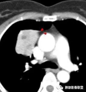 影像PPT - 【病例】肺硬化性细胞瘤1例CT定位分析-30 影像PPT - 【病例】肺硬化性细胞瘤1例CT定位分析-30