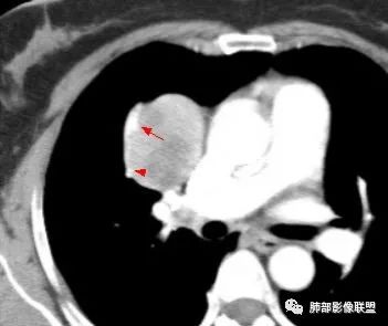 影像PPT - 【病例】肺硬化性细胞瘤1例CT定位分析-32 影像PPT - 【病例】肺硬化性细胞瘤1例CT定位分析-32