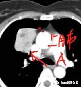 影像PPT - 【病例】肺硬化性细胞瘤1例CT定位分析-34 影像PPT - 【病例】肺硬化性细胞瘤1例CT定位分析-34