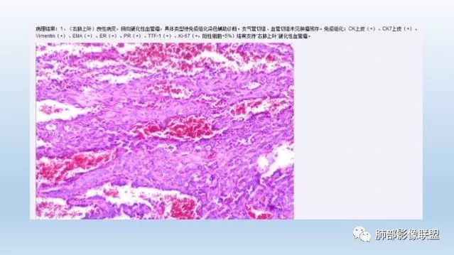 影像PPT - 【病例】肺硬化性细胞瘤1例CT定位分析-37 影像PPT - 【病例】肺硬化性细胞瘤1例CT定位分析-37