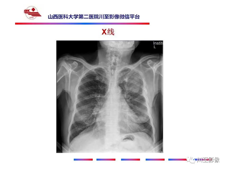 影像PPT - 【PPT】肺癌-5 影像PPT - 【PPT】肺癌-5