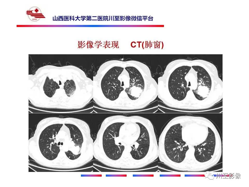 影像PPT - 【PPT】肺癌-7 影像PPT - 【PPT】肺癌-7