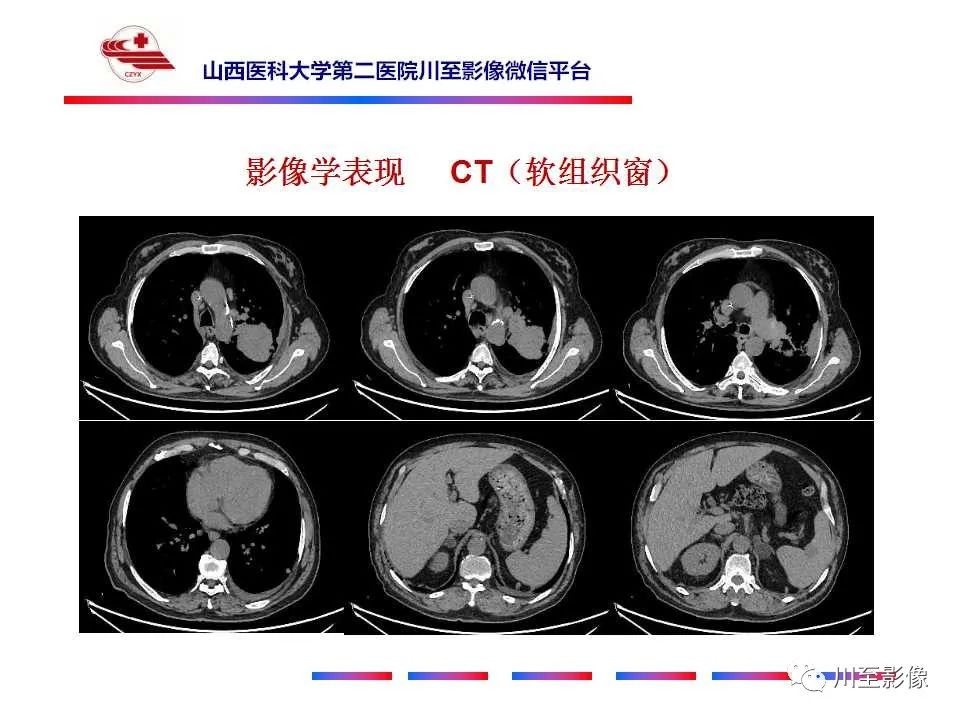 影像PPT - 【PPT】肺癌-8 影像PPT - 【PPT】肺癌-8