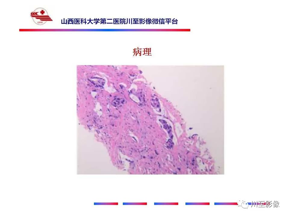 影像PPT - 【PPT】肺癌-11 影像PPT - 【PPT】肺癌-11