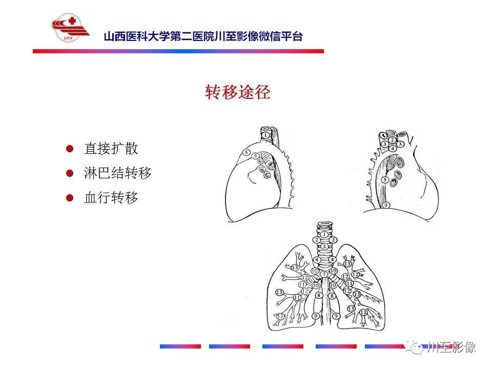 影像PPT - 【PPT】肺癌-21 影像PPT - 【PPT】肺癌-21