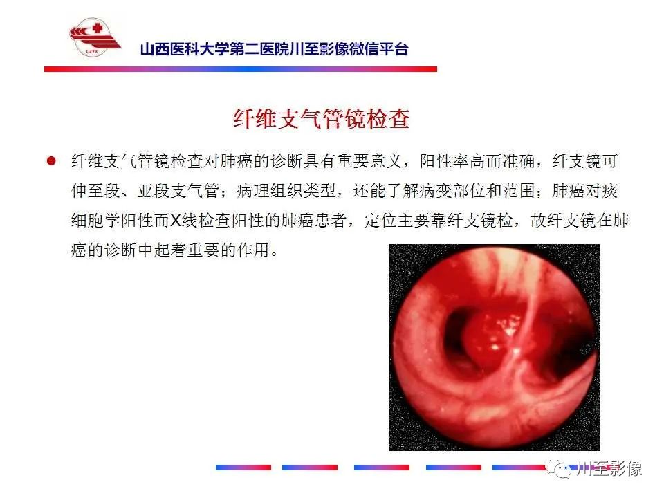 影像PPT - 【PPT】肺癌-30 影像PPT - 【PPT】肺癌-30