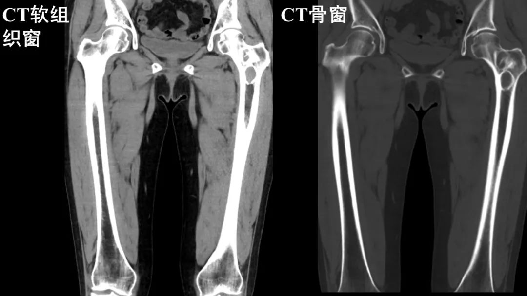 影像PPT - 【病例】股骨淀粉样瘤1例影像诊断及鉴别-2
