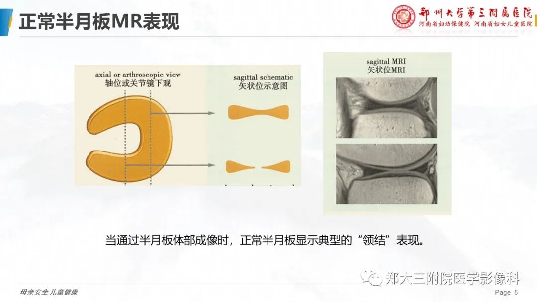 影像PPT - 【PPT】膝关节半月板病变的影像表现-5