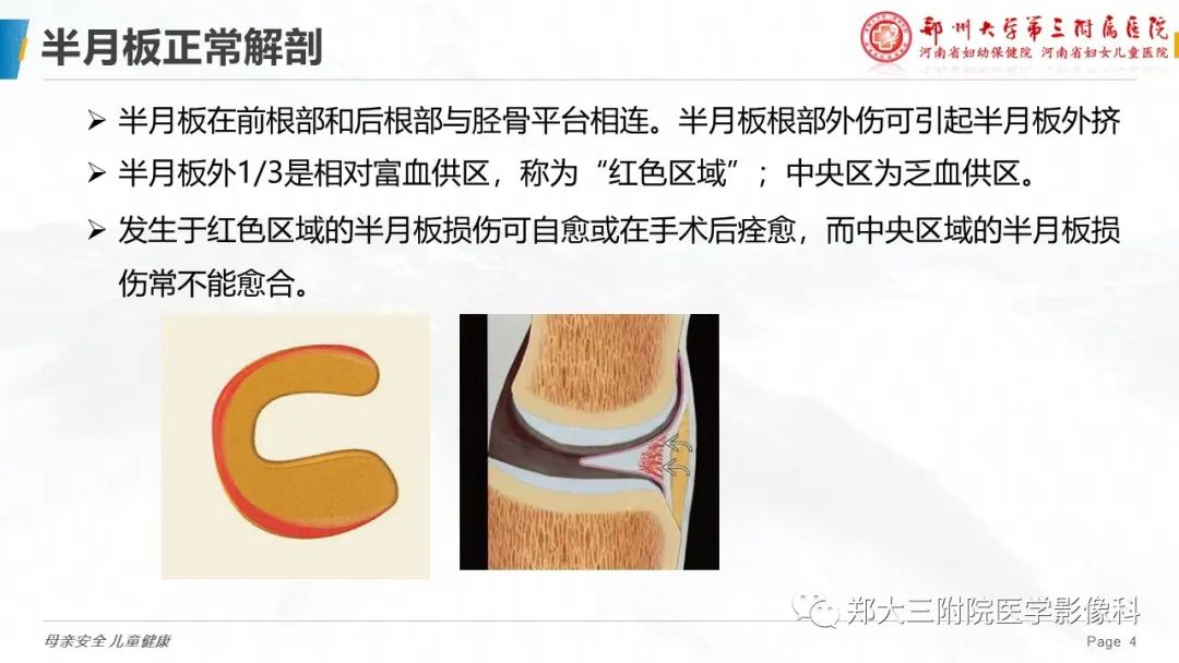 影像PPT - 【PPT】膝关节半月板病变的影像表现-4
