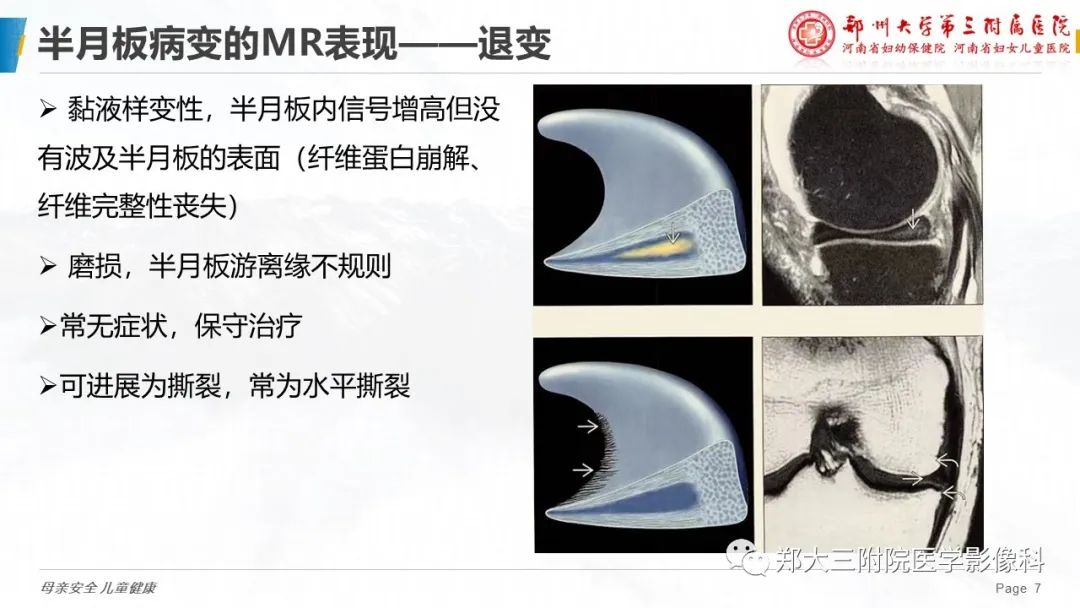 影像PPT - 【PPT】膝关节半月板病变的影像表现-7