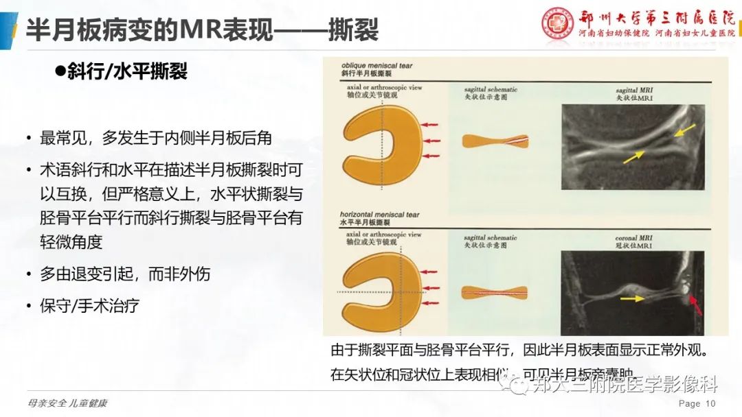 影像PPT - 【PPT】膝关节半月板病变的影像表现-10
