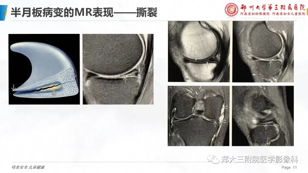 影像PPT - 【PPT】膝关节半月板病变的影像表现-11