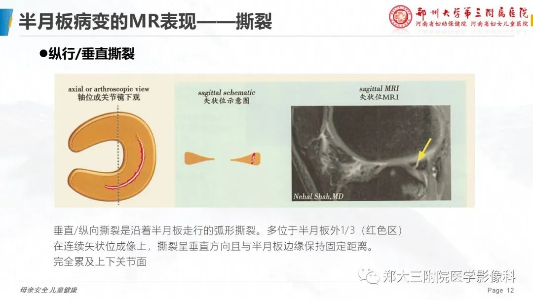 影像PPT - 【PPT】膝关节半月板病变的影像表现-12