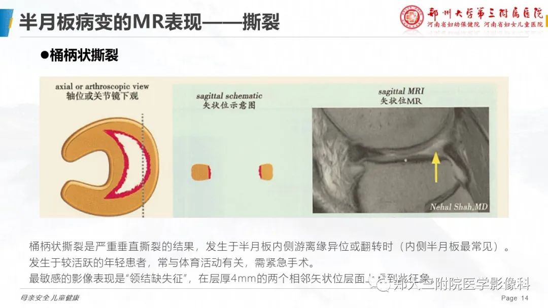 影像PPT - 【PPT】膝关节半月板病变的影像表现-14