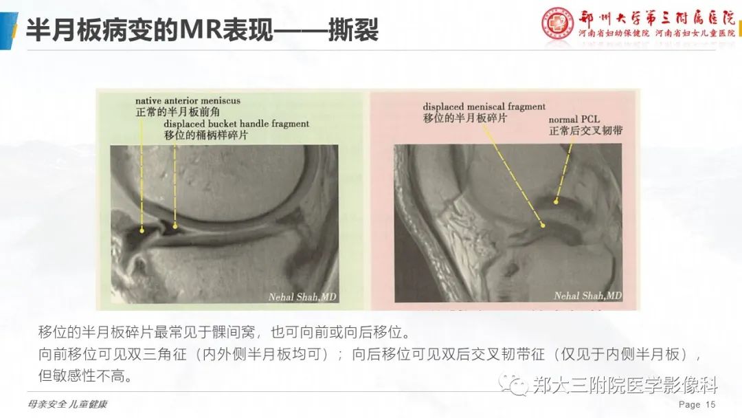 影像PPT - 【PPT】膝关节半月板病变的影像表现-15