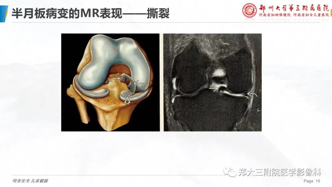 影像PPT - 【PPT】膝关节半月板病变的影像表现-16