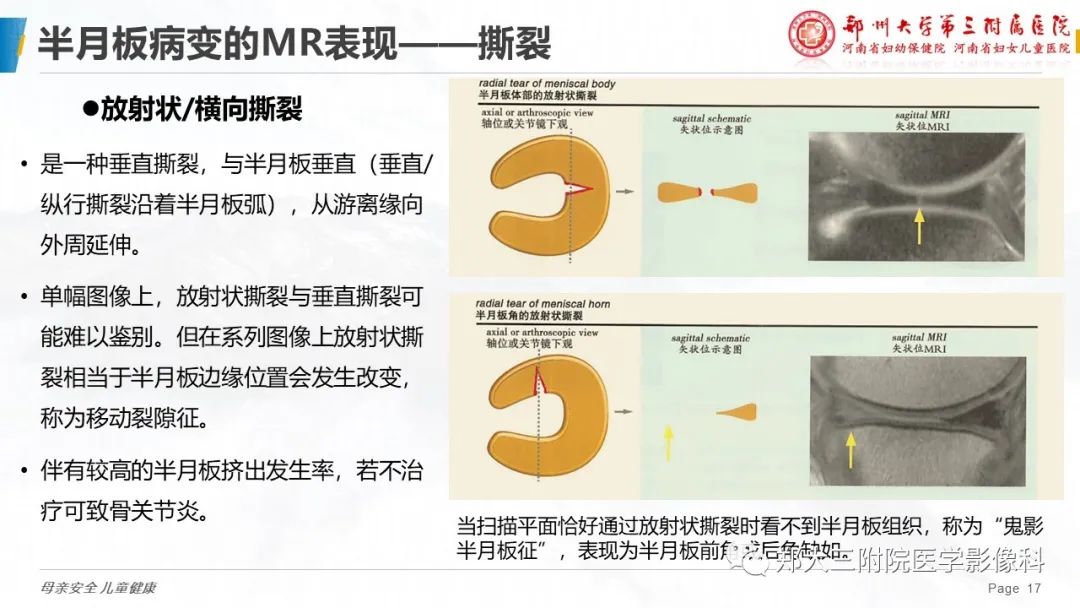 影像PPT - 【PPT】膝关节半月板病变的影像表现-17