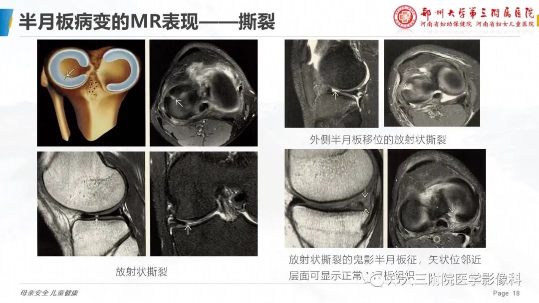 影像PPT - 【PPT】膝关节半月板病变的影像表现-18
