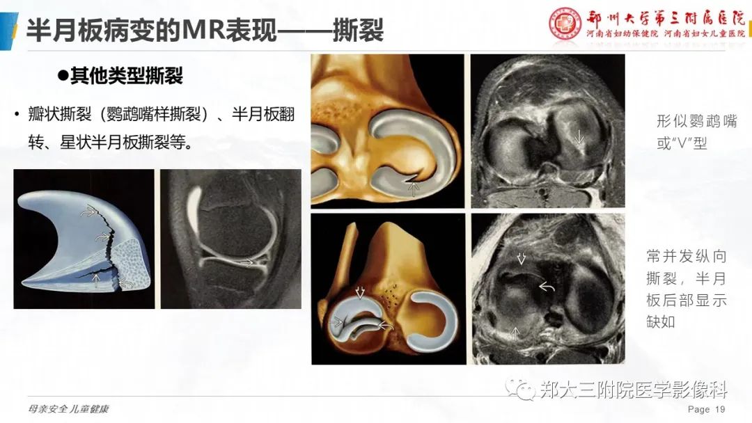 影像PPT - 【PPT】膝关节半月板病变的影像表现-19