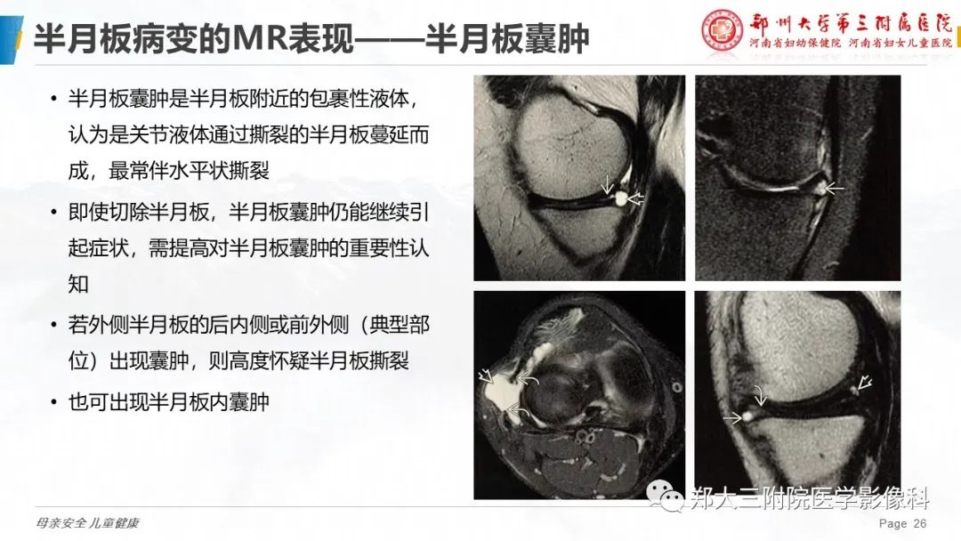 影像PPT - 【PPT】膝关节半月板病变的影像表现-26