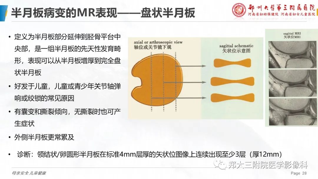 影像PPT - 【PPT】膝关节半月板病变的影像表现-28