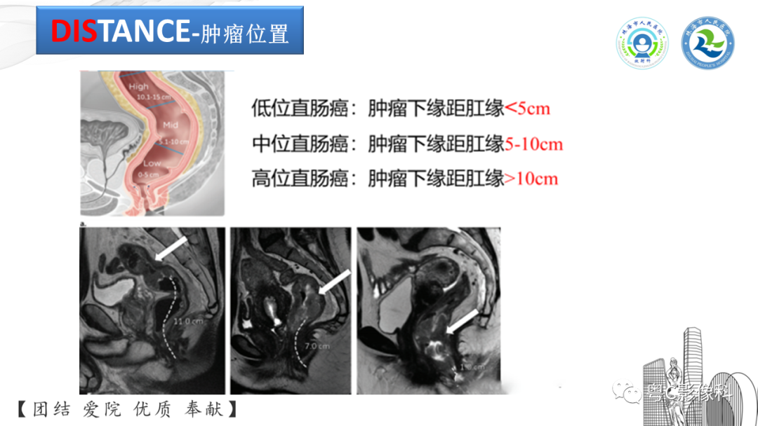 影像PPT - 【PPT】直肠癌—MR DISTANCE分期解读-5 影像PPT - 【PPT】直肠癌—MR DISTANCE分期解读-5