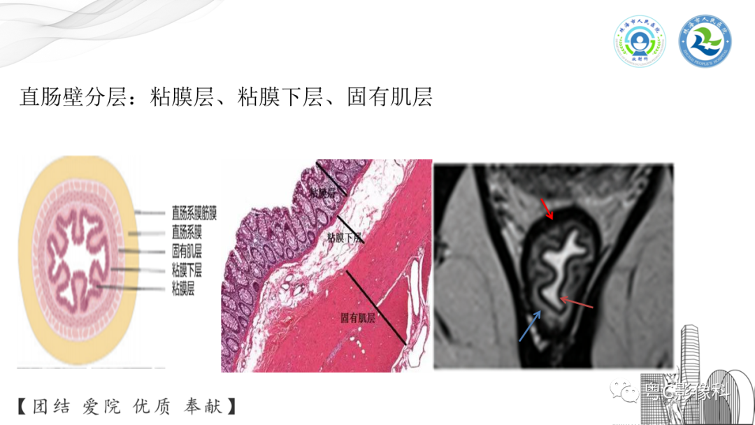 影像PPT - 【PPT】直肠癌—MR DISTANCE分期解读-9 影像PPT - 【PPT】直肠癌—MR DISTANCE分期解读-9