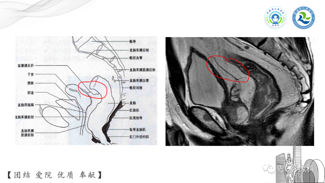影像PPT - 【PPT】直肠癌—MR DISTANCE分期解读-10 影像PPT - 【PPT】直肠癌—MR DISTANCE分期解读-10