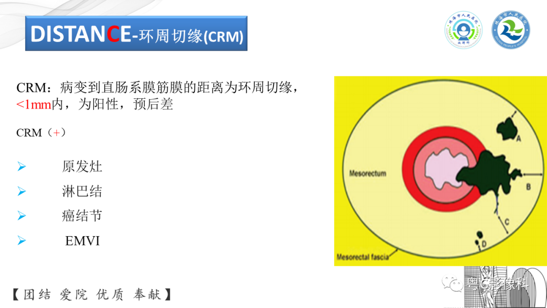 影像PPT - 【PPT】直肠癌—MR DISTANCE分期解读-21 影像PPT - 【PPT】直肠癌—MR DISTANCE分期解读-21