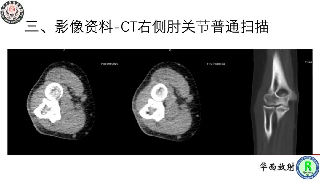 影像PPT - 【病例】肘关节滑膜肉瘤1例CT及MR影像-4