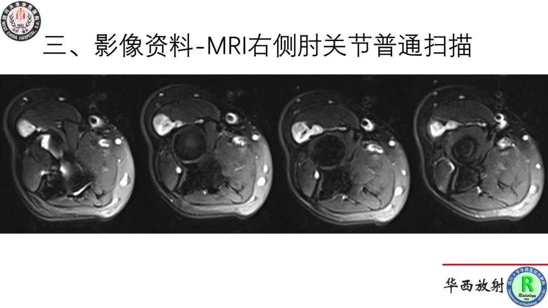 影像PPT - 【病例】肘关节滑膜肉瘤1例CT及MR影像-5