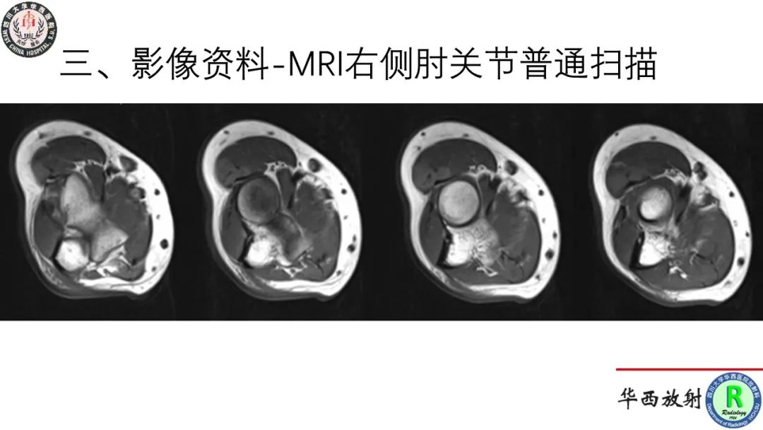 影像PPT - 【病例】肘关节滑膜肉瘤1例CT及MR影像-6