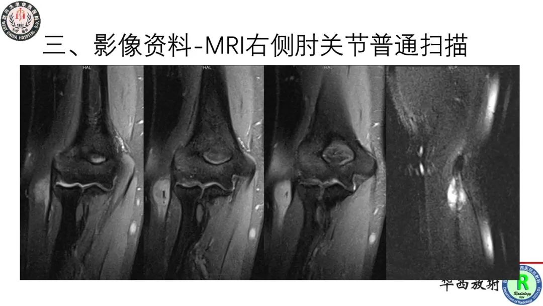 影像PPT - 【病例】肘关节滑膜肉瘤1例CT及MR影像-7