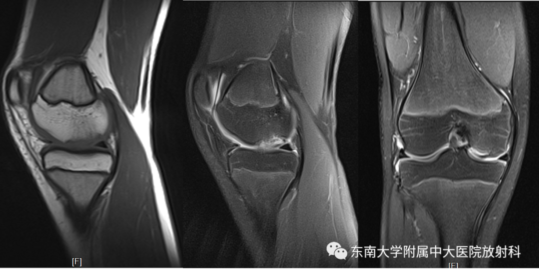 影像PPT - 【PPT】剥脱性骨软骨病-1