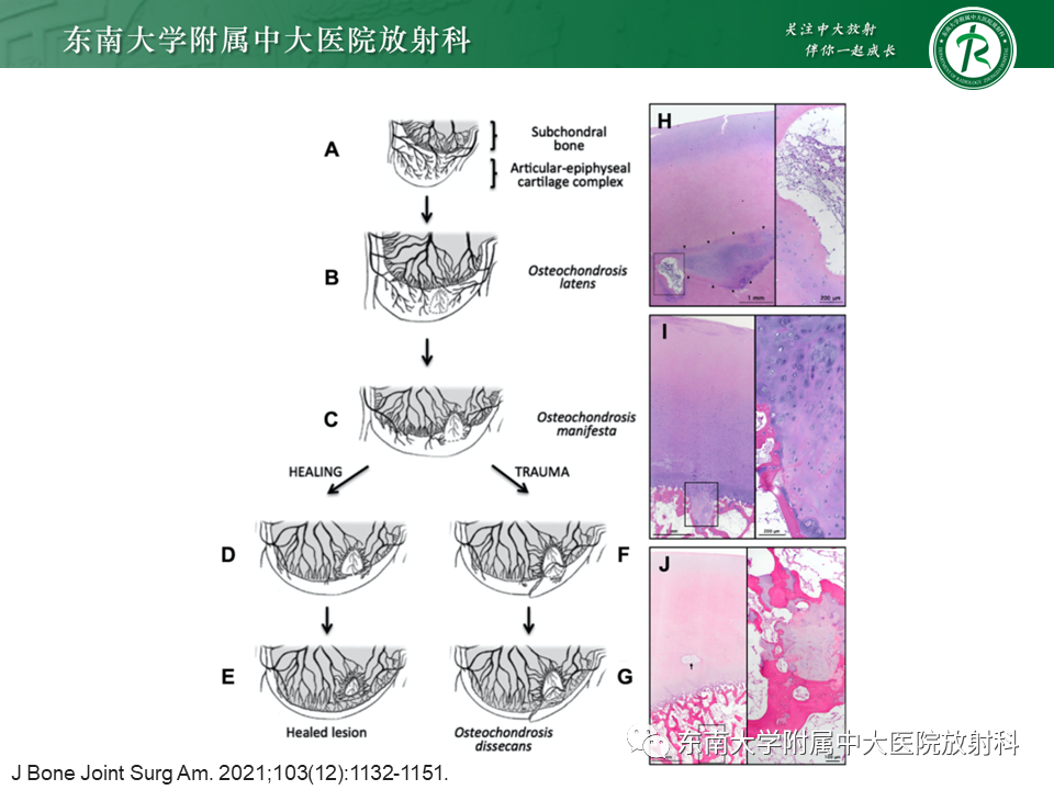 影像PPT - 【PPT】剥脱性骨软骨病-7