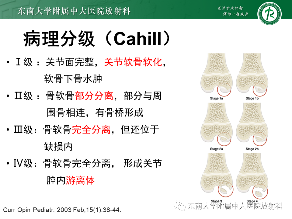 影像PPT - 【PPT】剥脱性骨软骨病-9