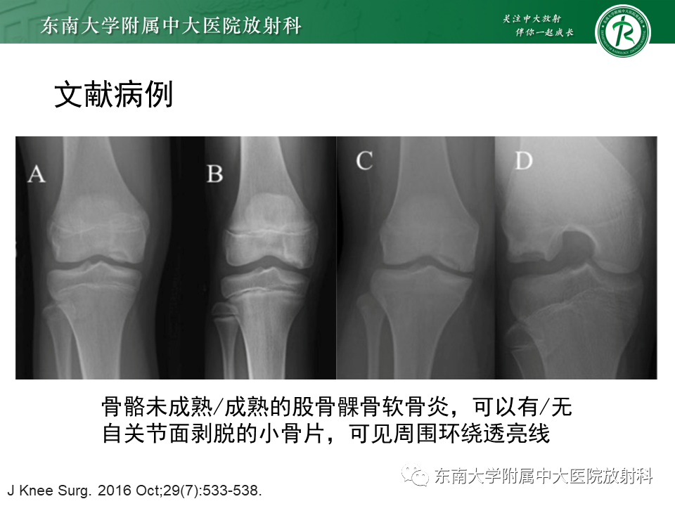 影像PPT - 【PPT】剥脱性骨软骨病-11