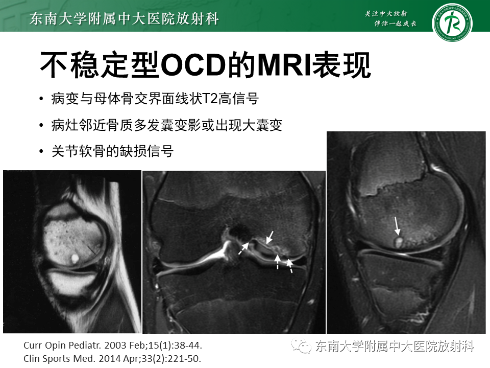 影像PPT - 【PPT】剥脱性骨软骨病-13