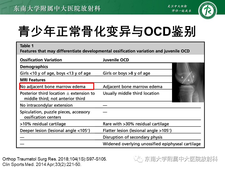 影像PPT - 【PPT】剥脱性骨软骨病-17