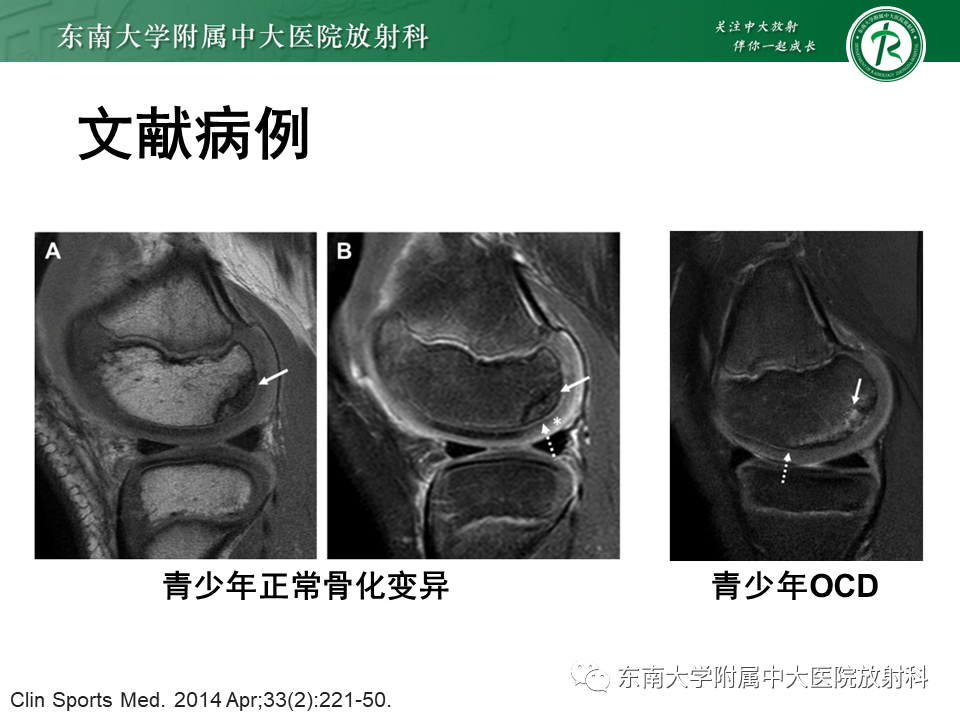 影像PPT - 【PPT】剥脱性骨软骨病-18