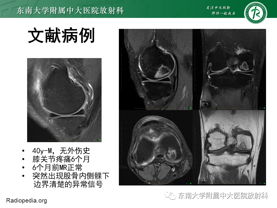 影像PPT - 【PPT】剥脱性骨软骨病-20