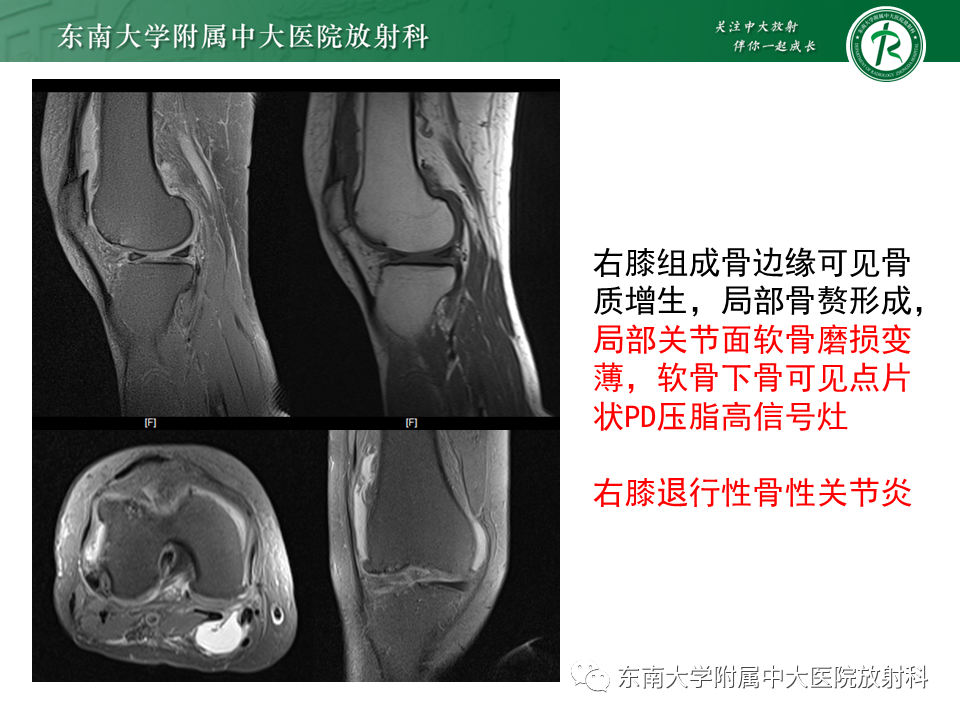 影像PPT - 【PPT】剥脱性骨软骨病-24