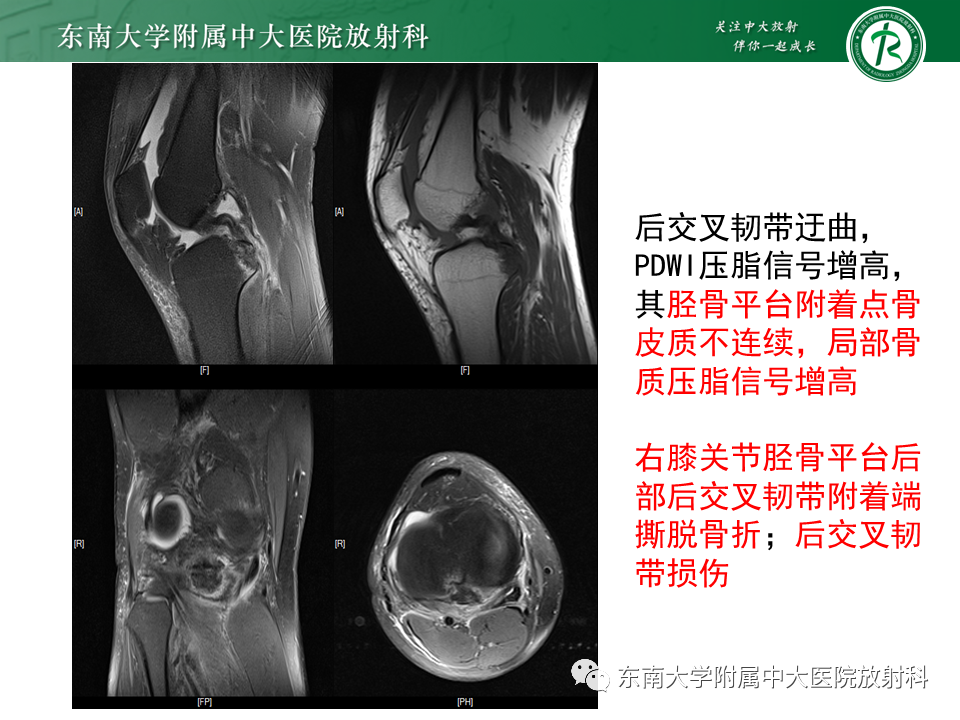 影像PPT - 【PPT】剥脱性骨软骨病-27