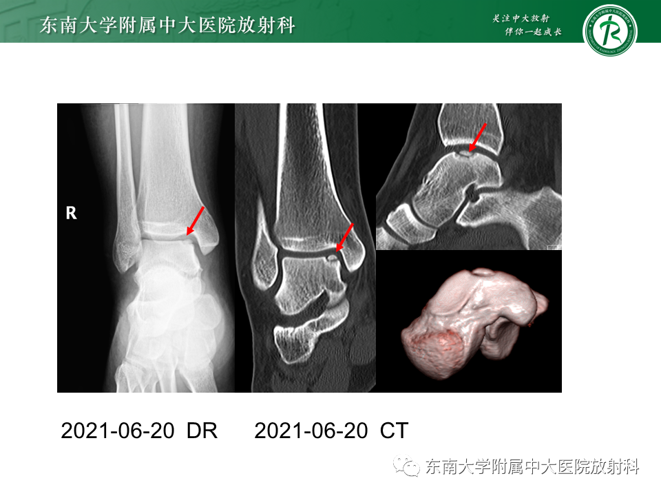 影像PPT - 【PPT】剥脱性骨软骨病-30